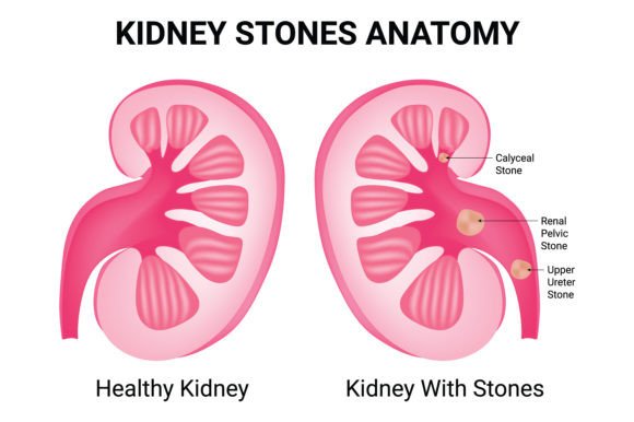 Download Kidney Stones Anatomy Science Design - Design Collection